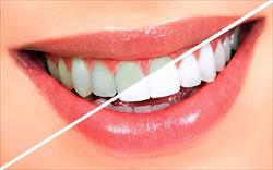 تحقیق درباره سفید کردن دندان
